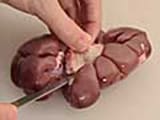 How to trim a Kidney - 2